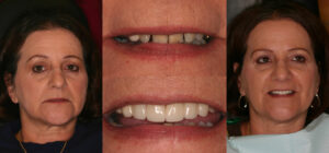 Before and after smile transformation — case 84, J. Ladd Williams Cosmetic Dentistry, Mesa AZ