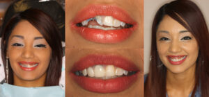 Before and after smile transformation — case 83, J. Ladd Williams Cosmetic Dentistry, Mesa AZ