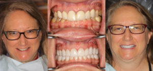 Before and after smile transformation — case 82, J. Ladd Williams Cosmetic Dentistry, Mesa AZ