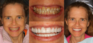 Before and after smile transformation — case 81, J. Ladd Williams Cosmetic Dentistry, Mesa AZ