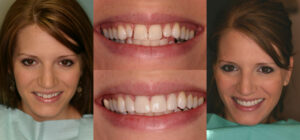 Before and after smile transformation — case 80, J. Ladd Williams Cosmetic Dentistry, Mesa AZ