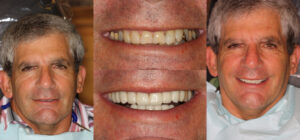 Before and after smile transformation — case 79, J. Ladd Williams Cosmetic Dentistry, Mesa AZ