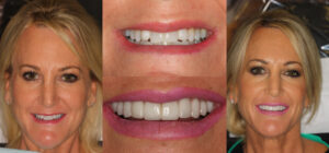 Before and after smile transformation — case 78, J. Ladd Williams Cosmetic Dentistry, Mesa AZ