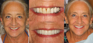 Before and after smile transformation — case 77, J. Ladd Williams Cosmetic Dentistry, Mesa AZ