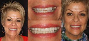 Before and after smile transformation — case 76, J. Ladd Williams Cosmetic Dentistry, Mesa AZ