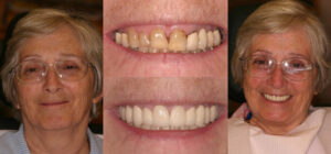 Before and after smile transformation — case 75, J. Ladd Williams Cosmetic Dentistry, Mesa AZ