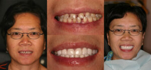 Before and after smile transformation — case 74, J. Ladd Williams Cosmetic Dentistry, Mesa AZ