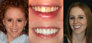 Before and after smile transformation — case 73, J. Ladd Williams Cosmetic Dentistry, Mesa AZ