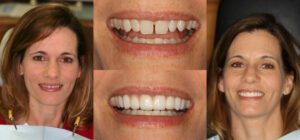Before and after smile transformation — case 72, J. Ladd Williams Cosmetic Dentistry, Mesa AZ