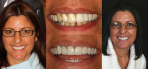 Before and after smile transformation — case 71, J. Ladd Williams Cosmetic Dentistry, Mesa AZ