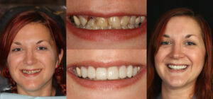 Before and after smile transformation — case 70, J. Ladd Williams Cosmetic Dentistry, Mesa AZ