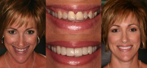 Before and after smile transformation — case 69, J. Ladd Williams Cosmetic Dentistry, Mesa AZ