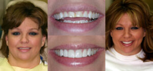 Before and after smile transformation — case 68, J. Ladd Williams Cosmetic Dentistry, Mesa AZ