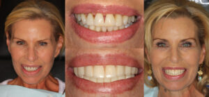 Before and after smile transformation — case 67, J. Ladd Williams Cosmetic Dentistry, Mesa AZ