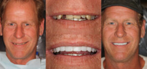 Before and after smile transformation — case 66, J. Ladd Williams Cosmetic Dentistry, Mesa AZ