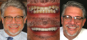 Before and after smile transformation — case 65, J. Ladd Williams Cosmetic Dentistry, Mesa AZ