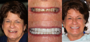 Before and after smile transformation — case 64, J. Ladd Williams Cosmetic Dentistry, Mesa AZ
