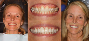 Before and after smile transformation — case 63, J. Ladd Williams Cosmetic Dentistry, Mesa AZ