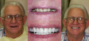 Before and after smile transformation — case 62, J. Ladd Williams Cosmetic Dentistry, Mesa AZ