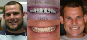 Before and after smile transformation — case 61, J. Ladd Williams Cosmetic Dentistry, Mesa AZ