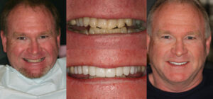 Before and after smile transformation — case 60, J. Ladd Williams Cosmetic Dentistry, Mesa AZ