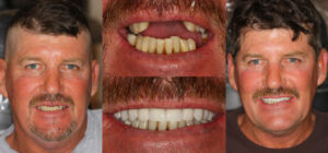 Before and after smile transformation — case 59, J. Ladd Williams Cosmetic Dentistry, Mesa AZ