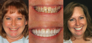 Before and after smile transformation — case 58, J. Ladd Williams Cosmetic Dentistry, Mesa AZ
