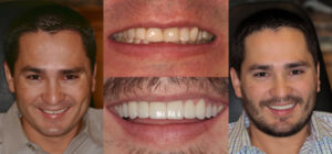 Before and after smile transformation — case 57, J. Ladd Williams Cosmetic Dentistry, Mesa AZ