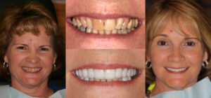 Before and after smile transformation — case 52, J. Ladd Williams Cosmetic Dentistry, Mesa AZ