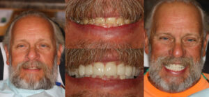 Before and after smile transformation — case 55, J. Ladd Williams Cosmetic Dentistry, Mesa AZ