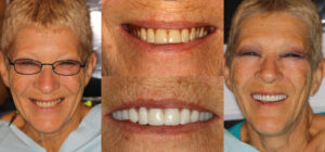 Before and after smile transformation — case 54, J. Ladd Williams Cosmetic Dentistry, Mesa AZ