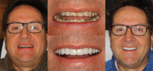 Before and after smile transformation — case 53, J. Ladd Williams Cosmetic Dentistry, Mesa AZ