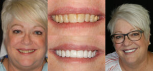 Before and after smile transformation — case 56, J. Ladd Williams Cosmetic Dentistry, Mesa AZ
