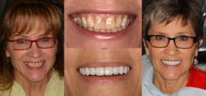 Before and after smile transformation — case 51, J. Ladd Williams Cosmetic Dentistry, Mesa AZ