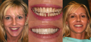 Before and after smile transformation — case 50, J. Ladd Williams Cosmetic Dentistry, Mesa AZ