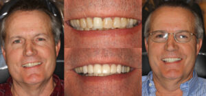 Before and after smile transformation — case 49, J. Ladd Williams Cosmetic Dentistry, Mesa AZ