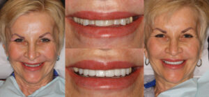 Before and after smile transformation — case 48, J. Ladd Williams Cosmetic Dentistry, Mesa AZ