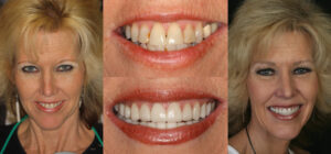 Before and after smile transformation — case 47, J. Ladd Williams Cosmetic Dentistry, Mesa AZ