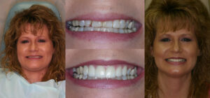 Before and after smile transformation — case 46, J. Ladd Williams Cosmetic Dentistry, Mesa AZ
