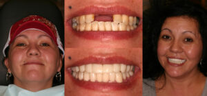 Before and after smile transformation — case 45, J. Ladd Williams Cosmetic Dentistry, Mesa AZ