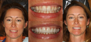 Before and after smile transformation — case 44, J. Ladd Williams Cosmetic Dentistry, Mesa AZ