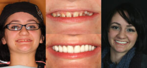 Before and after smile transformation — case 43, J. Ladd Williams Cosmetic Dentistry, Mesa AZ