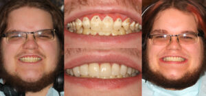Before and after smile transformation — case 42, J. Ladd Williams Cosmetic Dentistry, Mesa AZ
