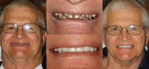 Before and after smile transformation — case 41, J. Ladd Williams Cosmetic Dentistry, Mesa AZ