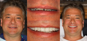 Before and after smile transformation — case 40, J. Ladd Williams Cosmetic Dentistry, Mesa AZ
