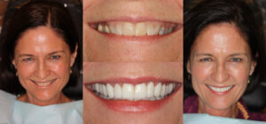 Before and after smile transformation — case 39, J. Ladd Williams Cosmetic Dentistry, Mesa AZ