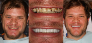 Before and after smile transformation — case 38, J. Ladd Williams Cosmetic Dentistry, Mesa AZ