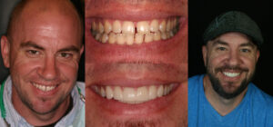 Before and after smile transformation — case 37, J. Ladd Williams Cosmetic Dentistry, Mesa AZ