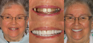 Before and after smile transformation — case 36, J. Ladd Williams Cosmetic Dentistry, Mesa AZ