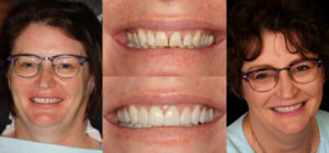 Before and after smile transformation — case 35, J. Ladd Williams Cosmetic Dentistry, Mesa AZ